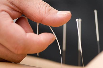 Acupuncture Needles